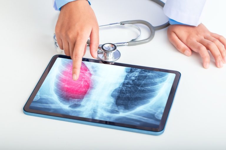 Lung Cancer Screening Guidelines: Are You Eligible?
